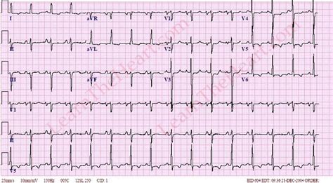 left ventricular strain.